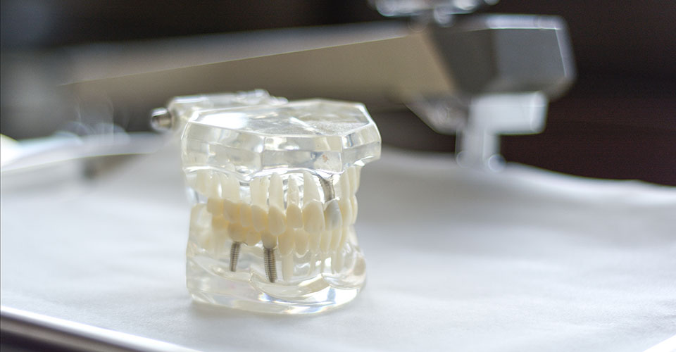 Durchsichtiges Zahnmodell mit Implantaten